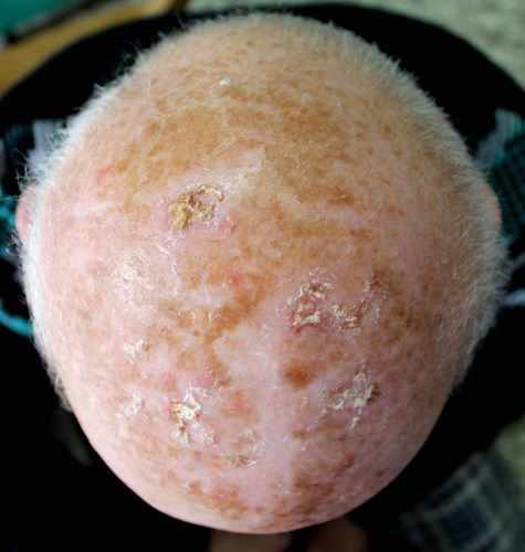 Actinic keratosis on the scalp of a man