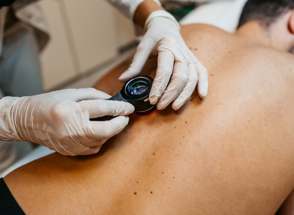 Melanoma Study Day