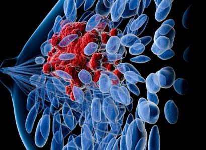 A graphic of a breast cancer tumour.