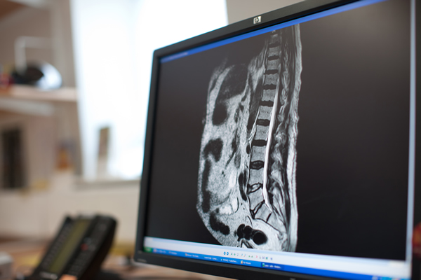Spinal cord compression: what it means and how it can be treated