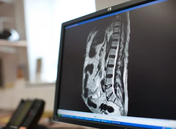 Spinal cord compression: what it means and how it can be treated