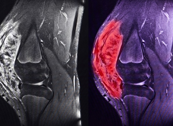A scan showing a sarcoma in black and white on the left, then highlighted in red and purple on the right.