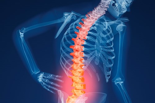 Osteoporosis