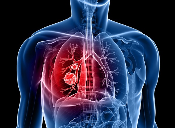 A graphic showing a cross-section of a body with a tumour in a lung.