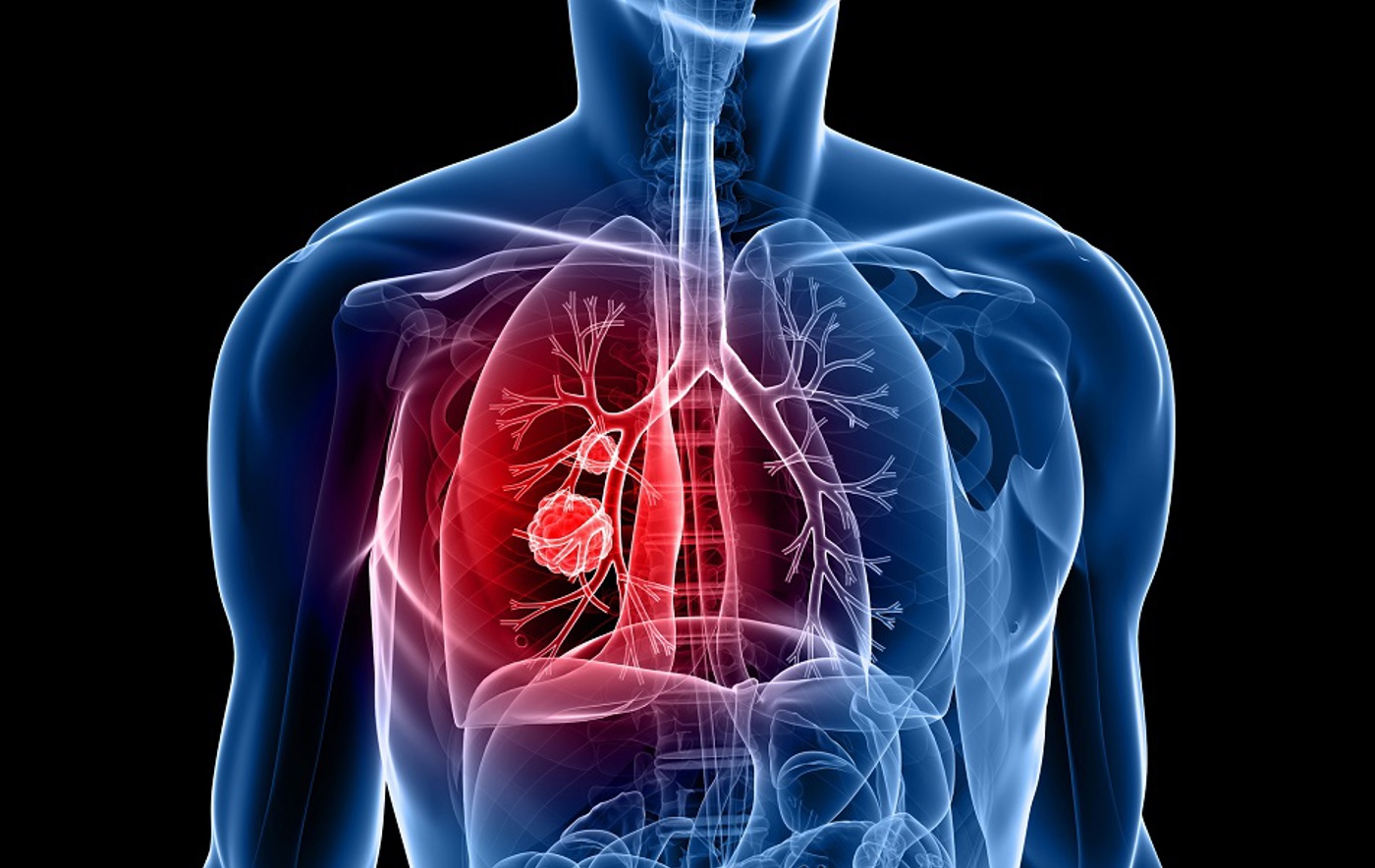 A graphic showing a cross-section of a body with a tumour in a lung.