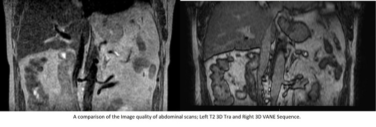 A comparison of the image quality of abdominal scans: left shows T2 3D tra and right show the 3D VANE sequence.