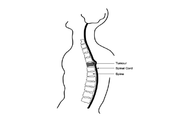 A line image showing the spinal column and spinal cord with tumour within the vertebra compressing the spinal cord at that level within the spine.